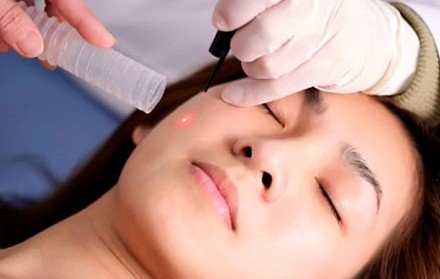 Trị nám bằng laser